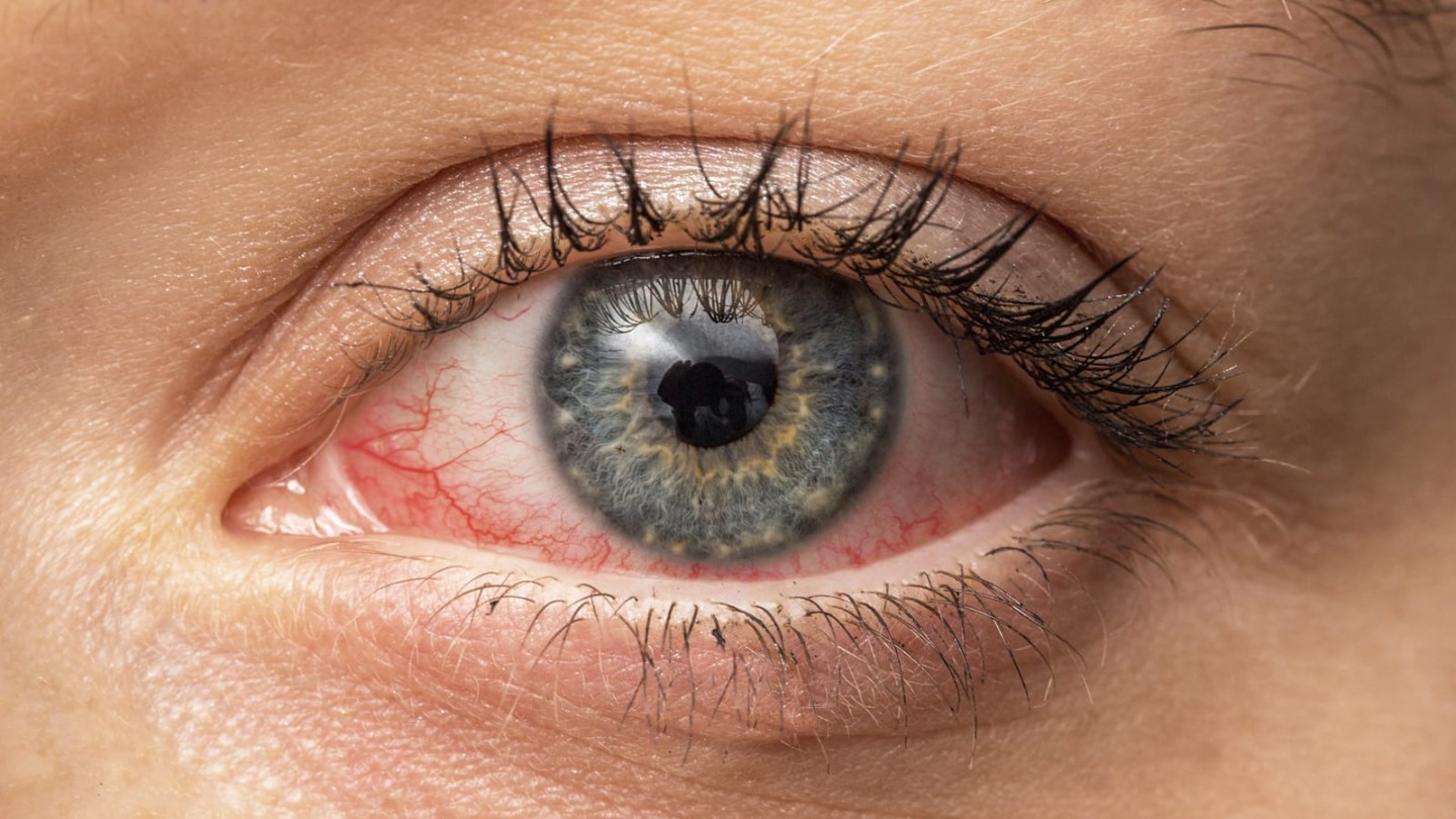 Syndróm suchého oka